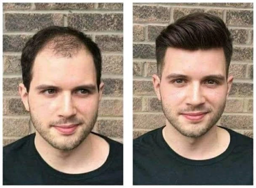 Benefits of hair bonding