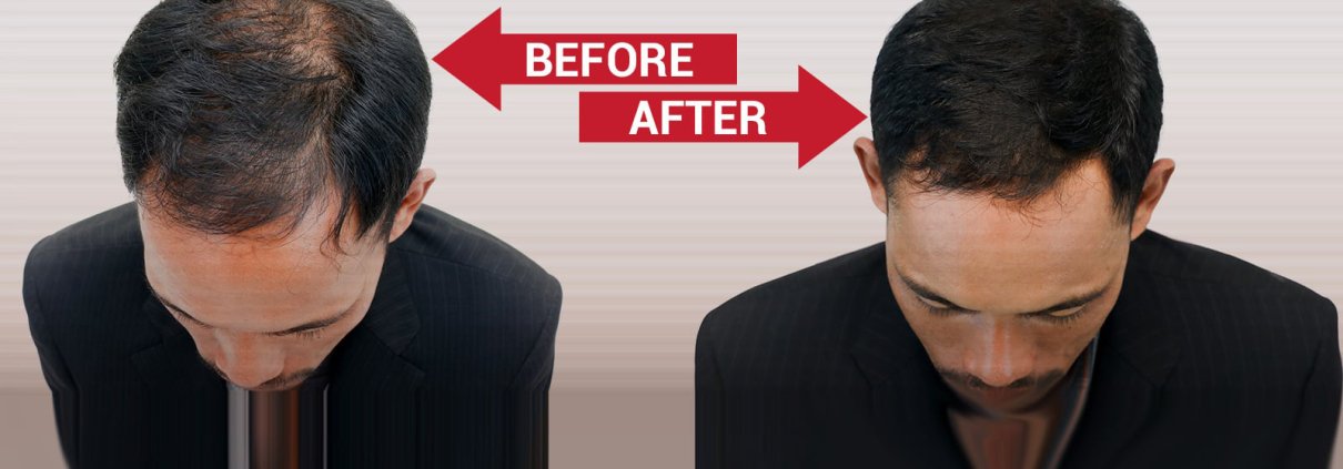 Hair-Bonding treatment