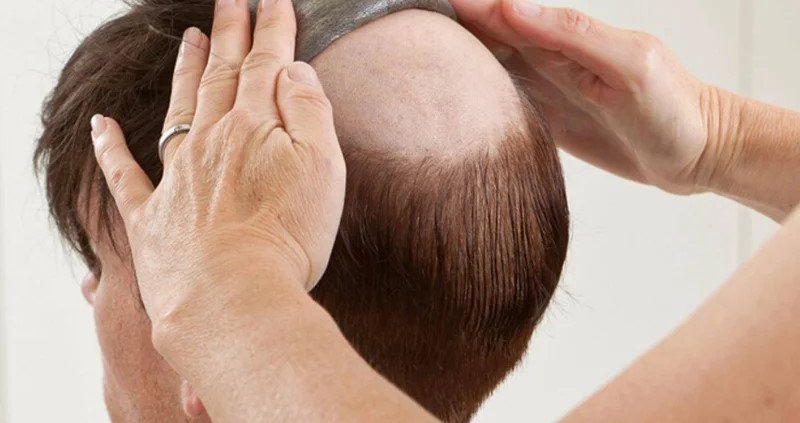 Hair Patch Clipping