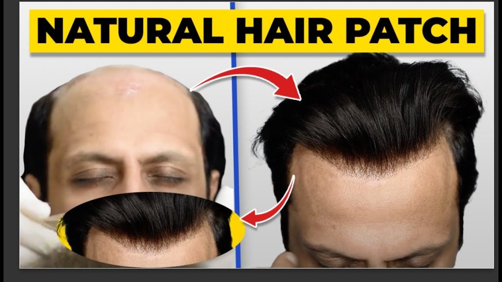 Hair Patch clip Services