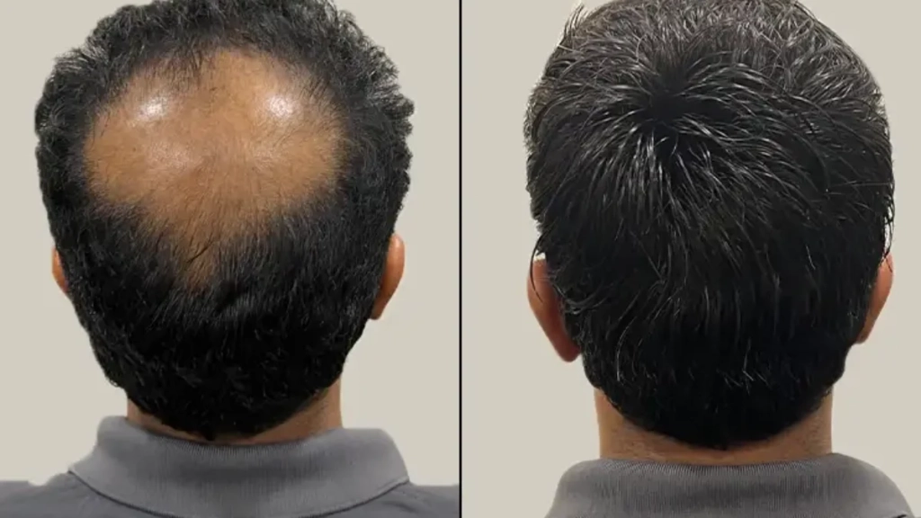 Hair patch treatment