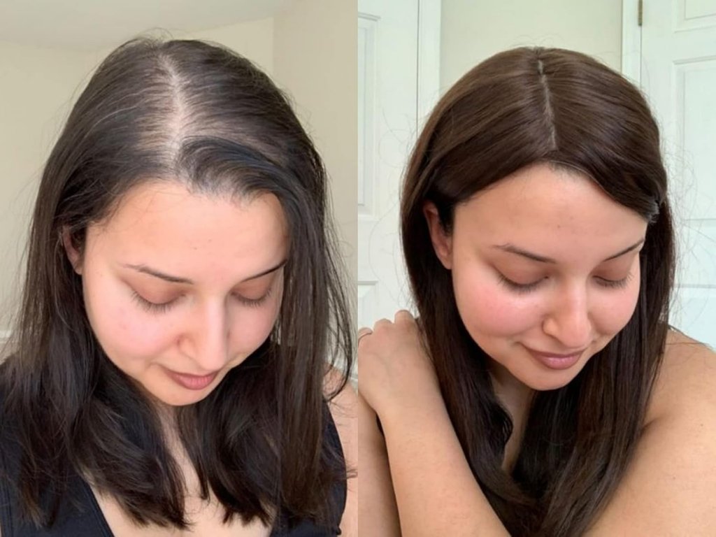 Thinning Hair